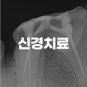 자연치아 보존 치료