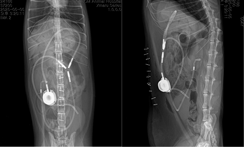 SUB 시스템 장착 후 복부 X-ray 2장