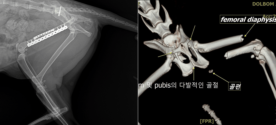 골절 수술 케이스