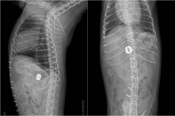 아메로이드 링 장착 후 복부 X-ray