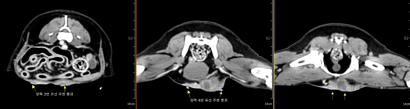 유선종양의 위치를 확인한 CT 축상 영상 3장