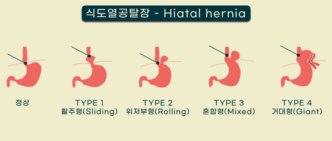 고양이 식도열공 탈장 수술 케이스 관련 이미지 2