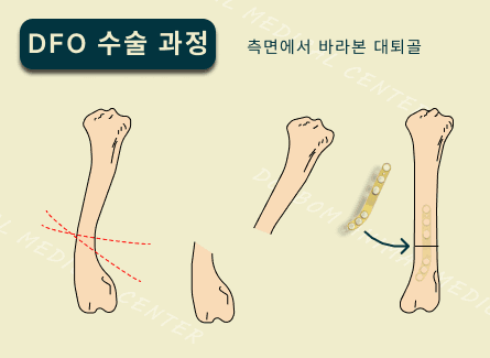 강아지 슬개골 탈구 DFO 교정 수술 관련 이미지 7